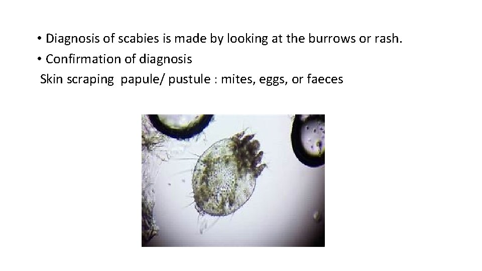  • Diagnosis of scabies is made by looking at the burrows or rash.