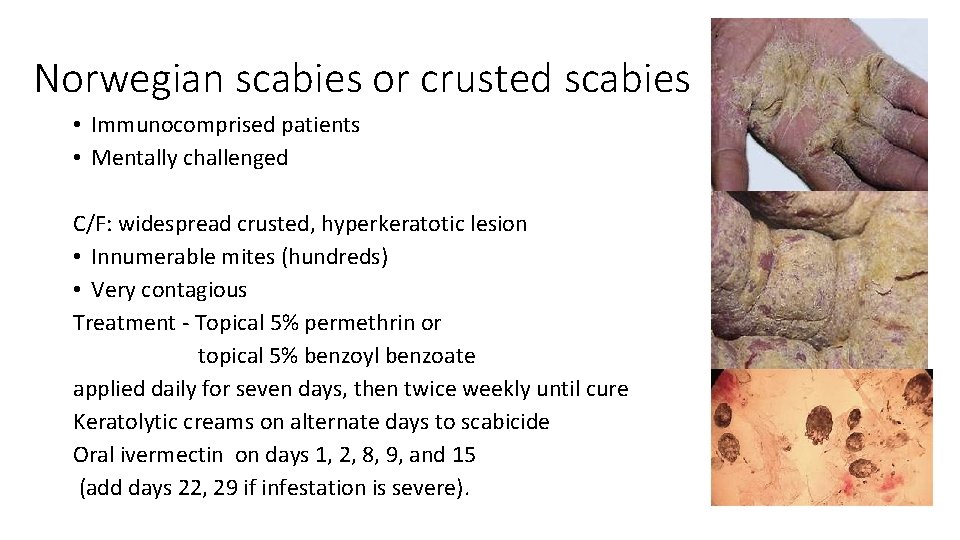 Norwegian scabies or crusted scabies • Immunocomprised patients • Mentally challenged C/F: widespread crusted,