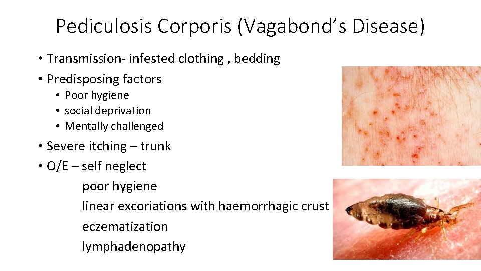 Pediculosis Corporis (Vagabond’s Disease) • Transmission- infested clothing , bedding • Predisposing factors •