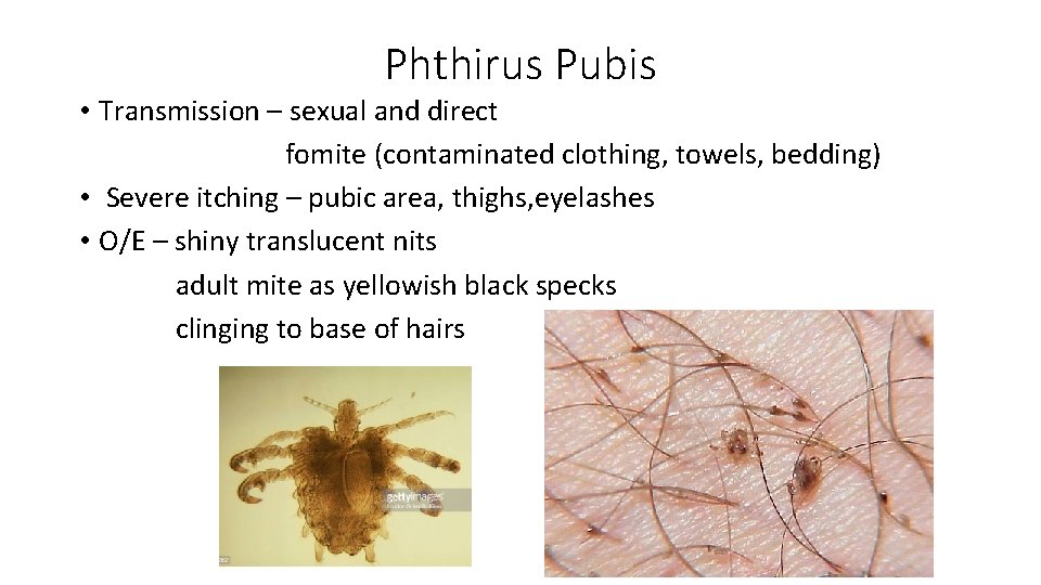 Phthirus Pubis • Transmission – sexual and direct fomite (contaminated clothing, towels, bedding) •