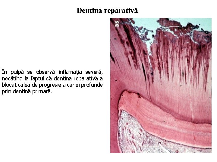 Dentina reparativă În pulpă se observă inflamaţia severă, necătînd la faptul că dentina reparativă