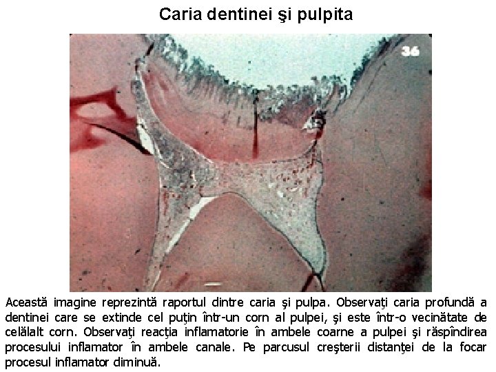 Caria dentinei şi pulpita Această imagine reprezintă raportul dintre caria şi pulpa. Observaţi caria