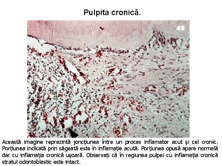 Pulpita cronică. Această imagine reprezintă joncţiunea între un proces inflamator acut şi cel cronic.