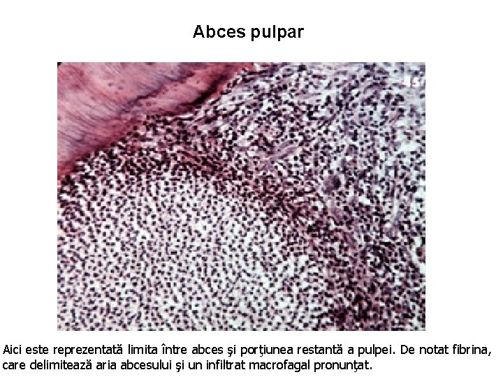 Abces pulpar Aici este reprezentată limita între abces şi porţiunea restantă a pulpei. De