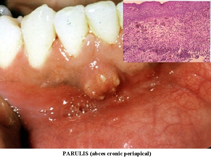 PARULIS (abces cronic periapical) 