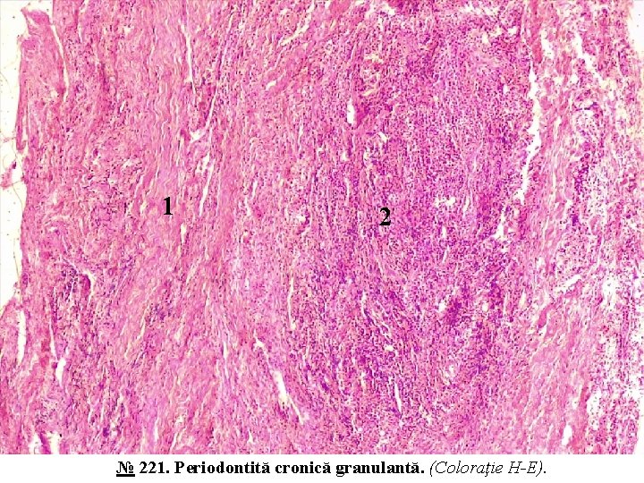 1 2 № 221. Periodontită cronică granulantă. (Coloraţie H-E). 