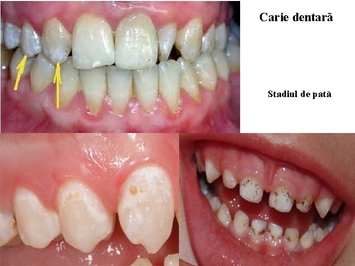 Carie dentară Stadiul de pată 