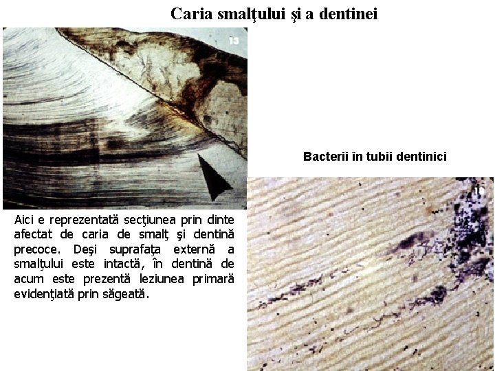 Caria smalţului şi a dentinei Bacterii în tubii dentinici Aici e reprezentată secţiunea prin