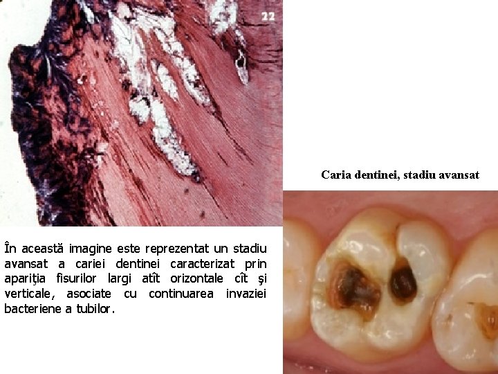 Caria dentinei, stadiu avansat În această imagine este reprezentat un stadiu avansat a cariei