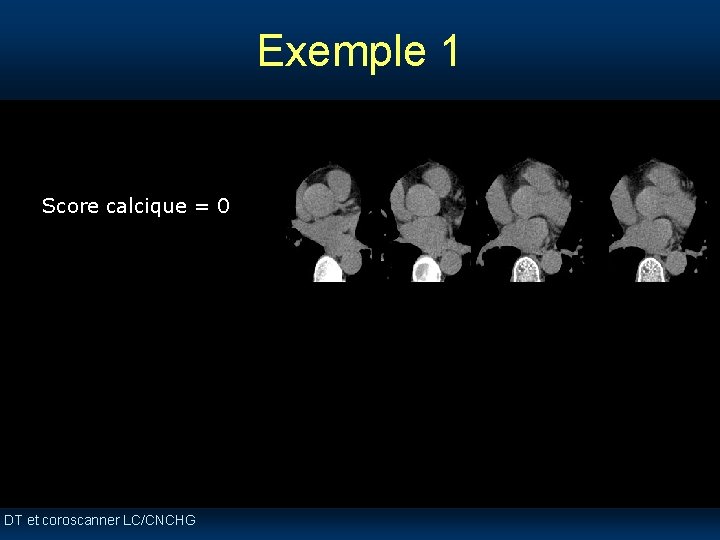 Exemple 1 Score calcique = 0 DT et coroscanner LC/CNCHG Exemple 1 Score calcique = 0 DT et coroscanner LC/CNCHG