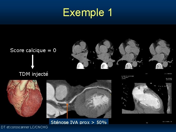 Exemple 1 Score calcique = 0 TDM injecté Sténose IVA prox > 50% DT Exemple 1 Score calcique = 0 TDM injecté Sténose IVA prox > 50% DT