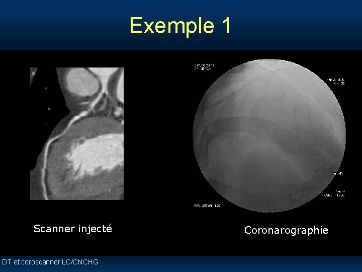 Exemple 1 Scanner injecté DT et coroscanner LC/CNCHG Coronarographie Exemple 1 Scanner injecté DT et coroscanner LC/CNCHG Coronarographie