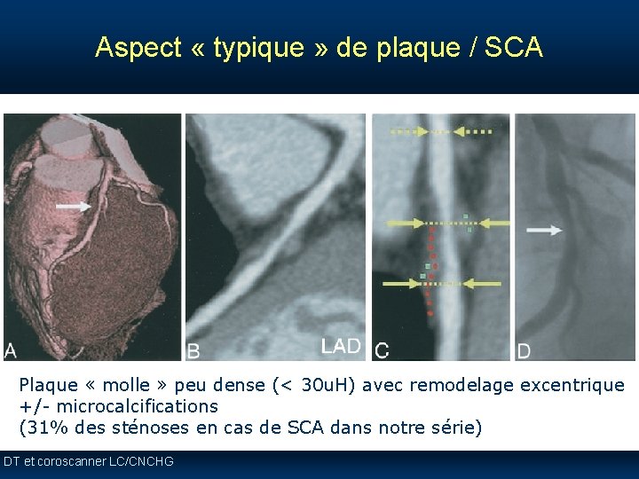 Aspect « typique » de plaque / SCA Plaque « molle » peu dense Aspect « typique » de plaque / SCA Plaque « molle » peu dense