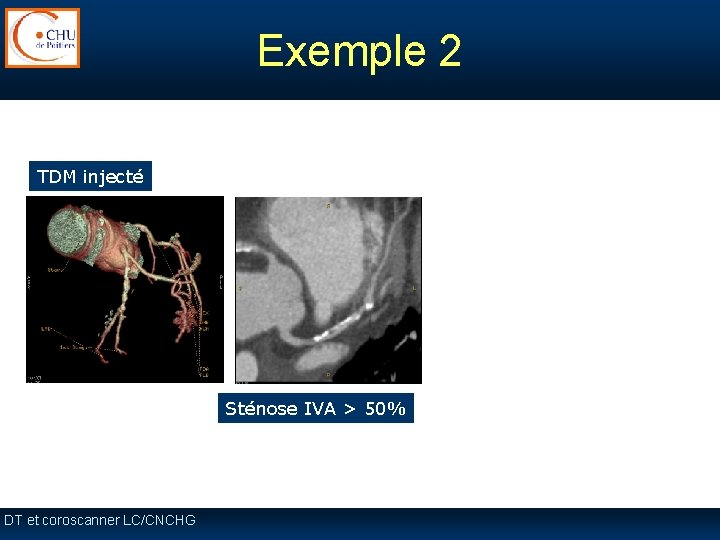 Exemple 2 TDM injecté Sténose IVA > 50% DT et coroscanner LC/CNCHG Exemple 2 TDM injecté Sténose IVA > 50% DT et coroscanner LC/CNCHG