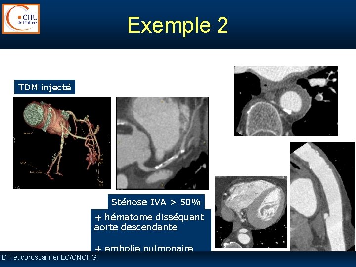 Exemple 2 TDM injecté Sténose IVA > 50% + hématome disséquant aorte descendante + Exemple 2 TDM injecté Sténose IVA > 50% + hématome disséquant aorte descendante +