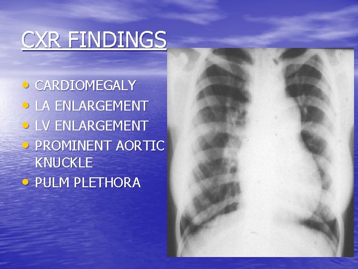 CXR FINDINGS • CARDIOMEGALY • LA ENLARGEMENT • LV ENLARGEMENT • PROMINENT AORTIC •