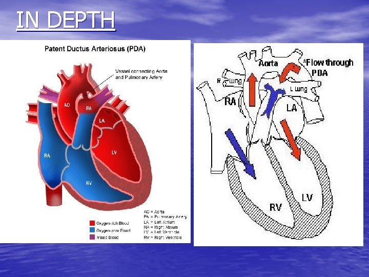 Patent ductus arteriosus An overview DEFINITION Patent ductus