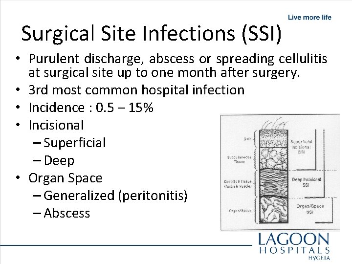 Surgical Site Infections (SSI) • Purulent discharge, abscess or spreading cellulitis at surgical site