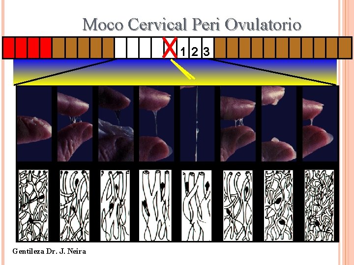 Moco Cervical Peri Ovulatorio 123 Gentileza Dr. J. Neira 