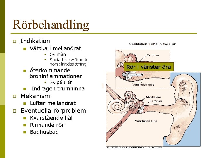 Rörbehandling p Indikation n Vätska i mellanörat § >6 mån § Socialt besvärande hörselnedsättning