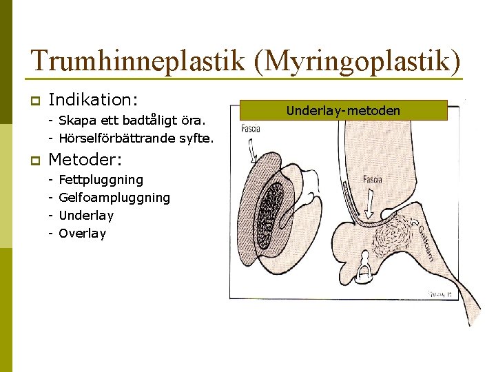 Trumhinneplastik (Myringoplastik) p Indikation: - Skapa ett badtåligt öra. - Hörselförbättrande syfte. p Metoder: