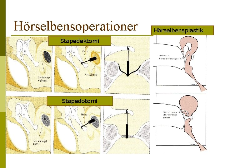 Hörselbensoperationer p Stapedektomi Indikationer: - Otoskleros - Avbrott i hörselbenskedjan - Hörselbensförlust Stapedotomi Hörselbensplastik