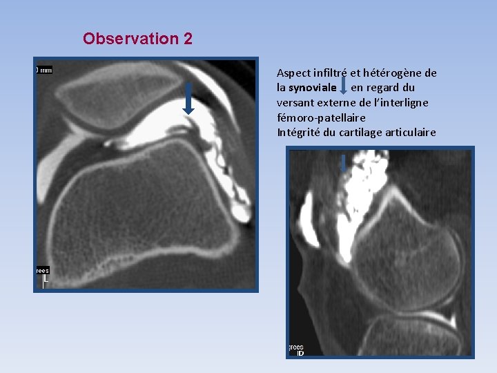 Observation 2 Aspect infiltré et hétérogène de la synoviale en regard du versant externe Observation 2 Aspect infiltré et hétérogène de la synoviale en regard du versant externe