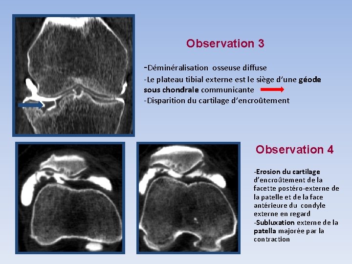 Observation 3 -Déminéralisation osseuse diffuse -Le plateau tibial externe est le siège d’une géode Observation 3 -Déminéralisation osseuse diffuse -Le plateau tibial externe est le siège d’une géode
