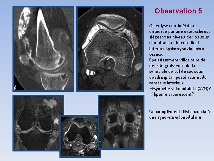 Observation 5 Ostéolyse centimétrique entourée par une ostéosclérose siégeant au niveau de l’os sous Observation 5 Ostéolyse centimétrique entourée par une ostéosclérose siégeant au niveau de l’os sous
