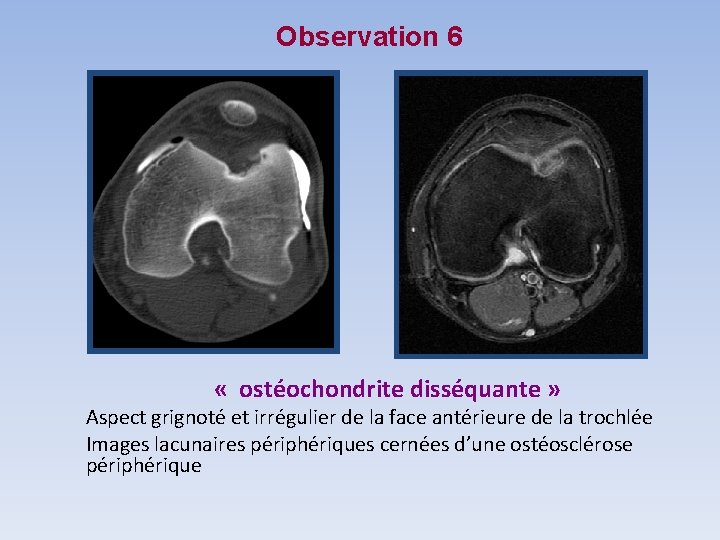 Observation 6 « ostéochondrite disséquante » Aspect grignoté et irrégulier de la face antérieure Observation 6 « ostéochondrite disséquante » Aspect grignoté et irrégulier de la face antérieure
