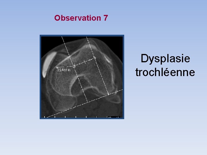 Observation 7 Dysplasie trochléenne Observation 7 Dysplasie trochléenne