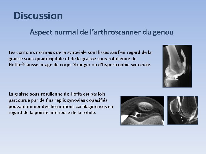 Discussion Aspect normal de l’arthroscanner du genou Les contours normaux de la synoviale sont Discussion Aspect normal de l’arthroscanner du genou Les contours normaux de la synoviale sont