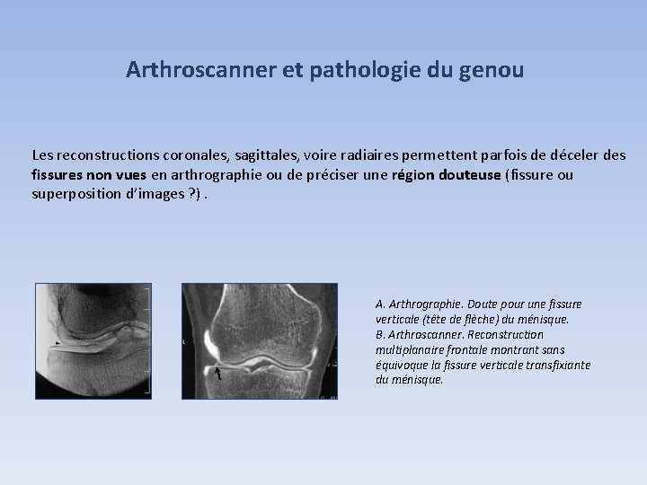 Arthroscanner et pathologie du genou Les reconstructions coronales, sagittales, voire radiaires permettent parfois de Arthroscanner et pathologie du genou Les reconstructions coronales, sagittales, voire radiaires permettent parfois de