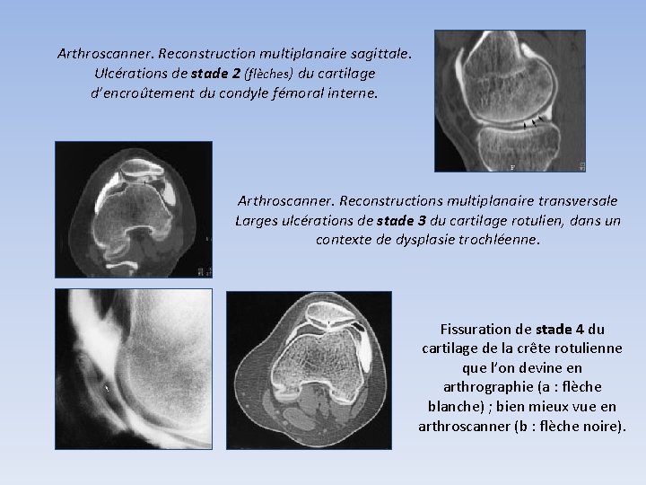 Arthroscanner. Reconstruction multiplanaire sagittale. Ulcérations de stade 2 (flèches) du cartilage d’encroûtement du condyle Arthroscanner. Reconstruction multiplanaire sagittale. Ulcérations de stade 2 (flèches) du cartilage d’encroûtement du condyle