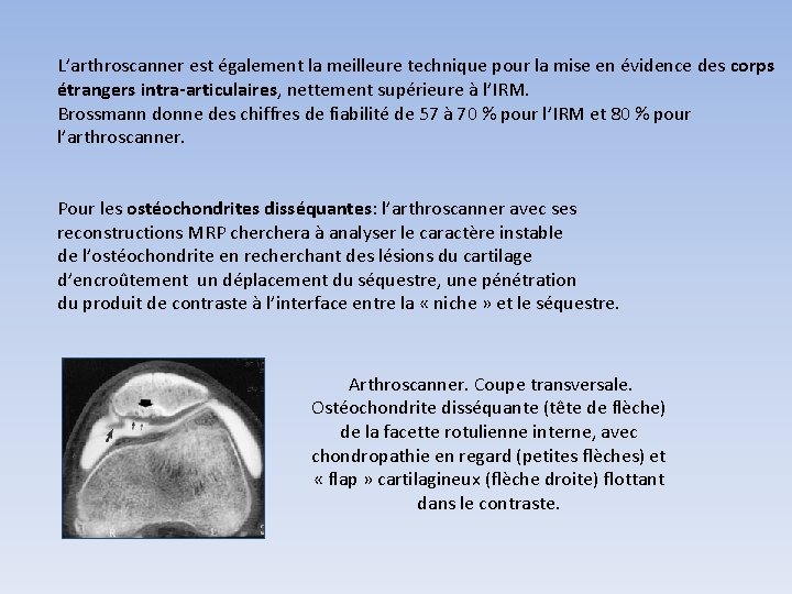 L’arthroscanner est également la meilleure technique pour la mise en évidence des corps étrangers L’arthroscanner est également la meilleure technique pour la mise en évidence des corps étrangers