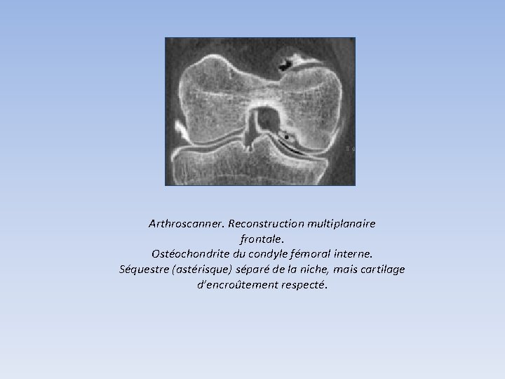 Arthroscanner. Reconstruction multiplanaire frontale. Ostéochondrite du condyle fémoral interne. Séquestre (astérisque) séparé de la Arthroscanner. Reconstruction multiplanaire frontale. Ostéochondrite du condyle fémoral interne. Séquestre (astérisque) séparé de la