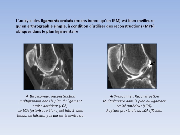 L’analyse des ligaments croisés (moins bonne qu’en IRM) est bien meilleure qu’en arthrographie simple, L’analyse des ligaments croisés (moins bonne qu’en IRM) est bien meilleure qu’en arthrographie simple,
