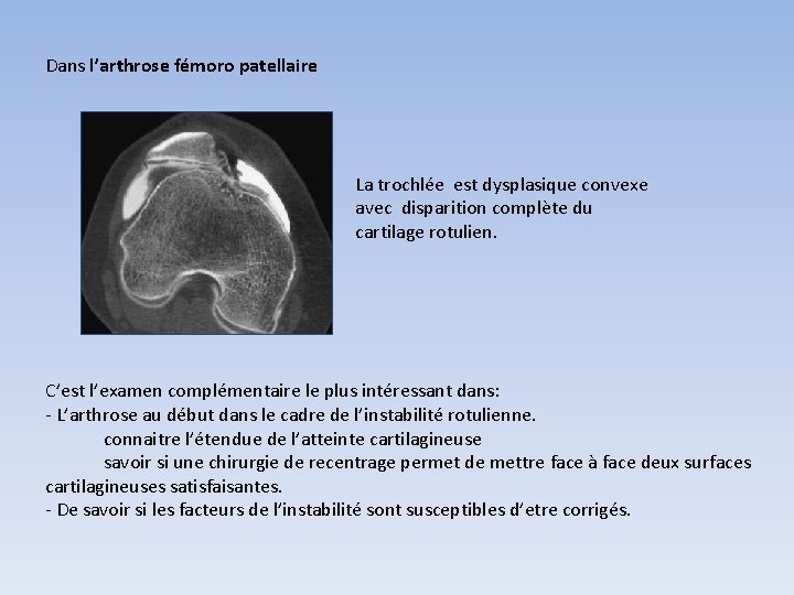 Dans l’arthrose fémoro patellaire La trochlée est dysplasique convexe avec disparition complète du cartilage Dans l’arthrose fémoro patellaire La trochlée est dysplasique convexe avec disparition complète du cartilage