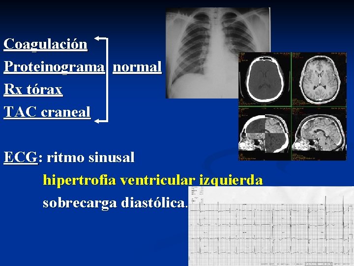 Coagulación Proteinograma normal Rx tórax TAC craneal ECG: ritmo sinusal hipertrofia ventricular izquierda sobrecarga