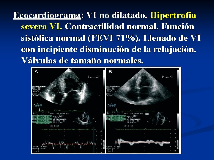 Ecocardiograma: VI no dilatado. Hipertrofia severa VI. Contractilidad normal. Función sistólica normal (FEVI 71%).