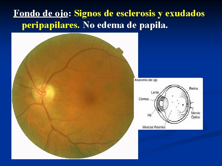 Fondo de ojo: Signos de esclerosis y exudados peripapilares. No edema de papila. 