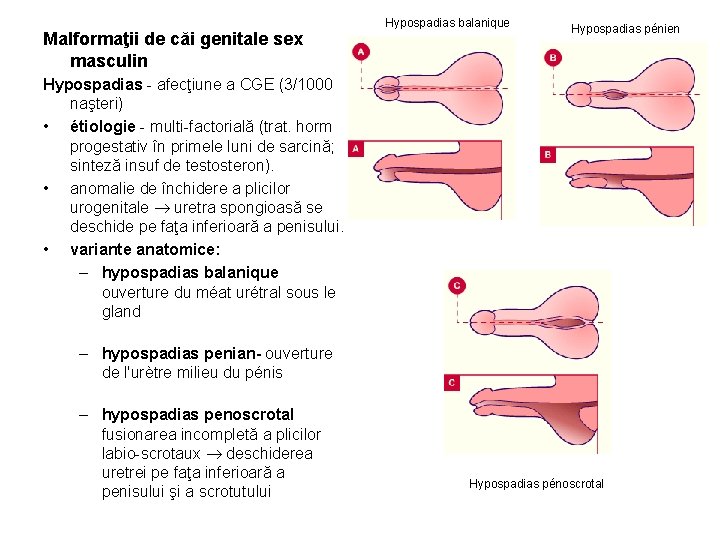 Malformaţii de căi genitale sex masculin Hypospadias balanique Hypospadias pénien Hypospadias - afecţiune a