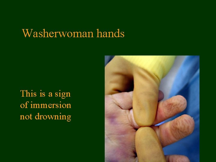 Washerwoman hands This is a sign of immersion not drowning 