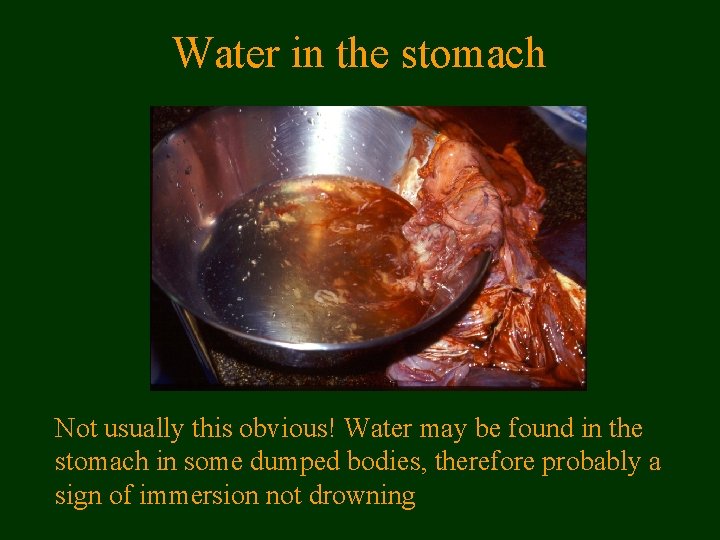 Water in the stomach Not usually this obvious! Water may be found in the