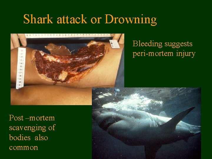 Shark attack or Drowning Bleeding suggests peri-mortem injury Post –mortem scavenging of bodies also