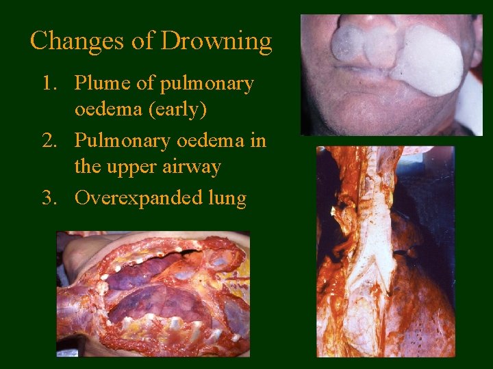 Changes of Drowning 1. Plume of pulmonary oedema (early) 2. Pulmonary oedema in the