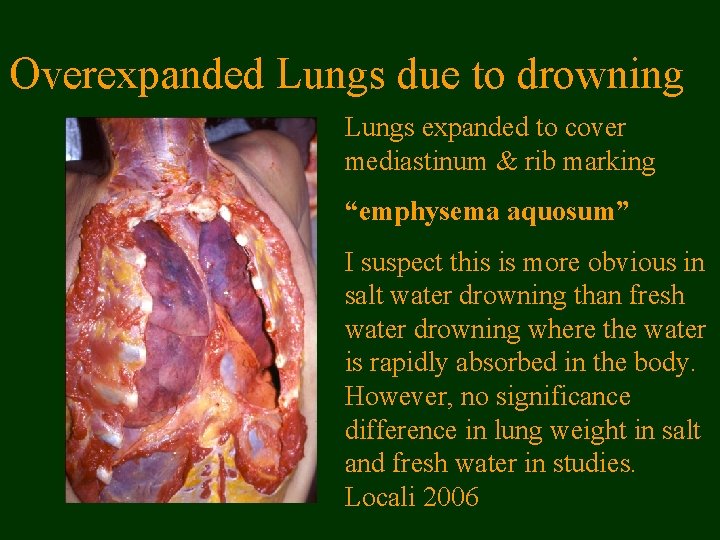 Overexpanded Lungs due to drowning Lungs expanded to cover mediastinum & rib marking “emphysema