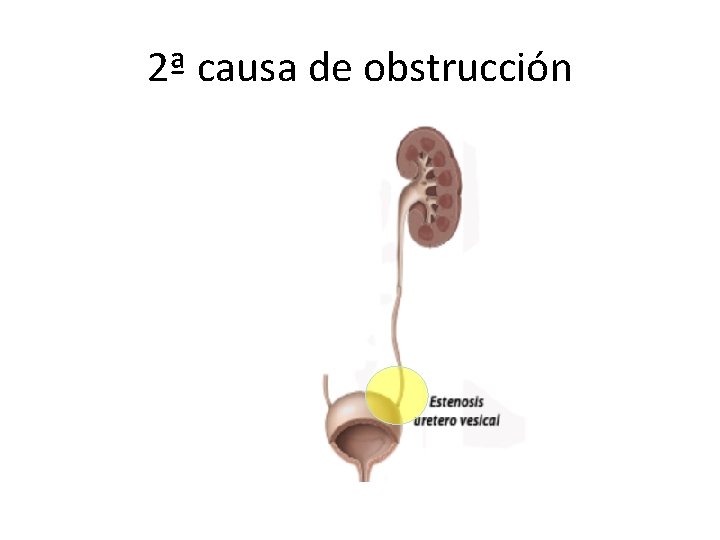 2ª causa de obstrucción 