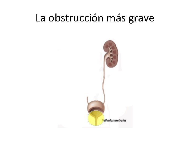 La obstrucción más grave 