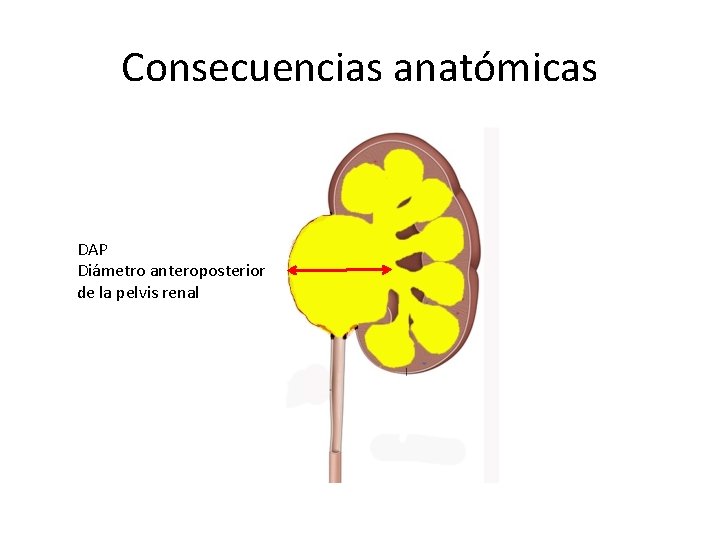 Consecuencias anatómicas DAP Diámetro anteroposterior de la pelvis renal 